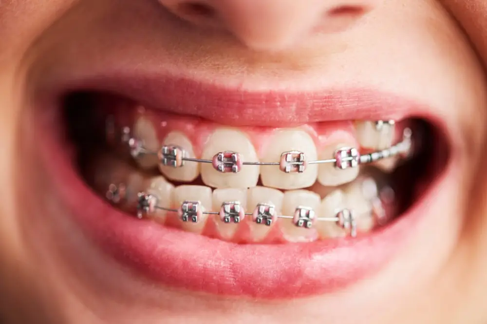 braces-01